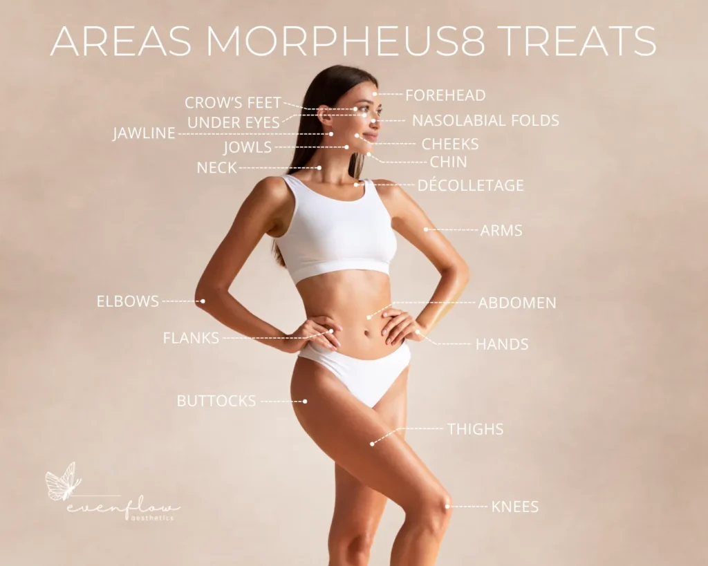 Graphic of woman with listed areas that Morpheus8 Burst treats